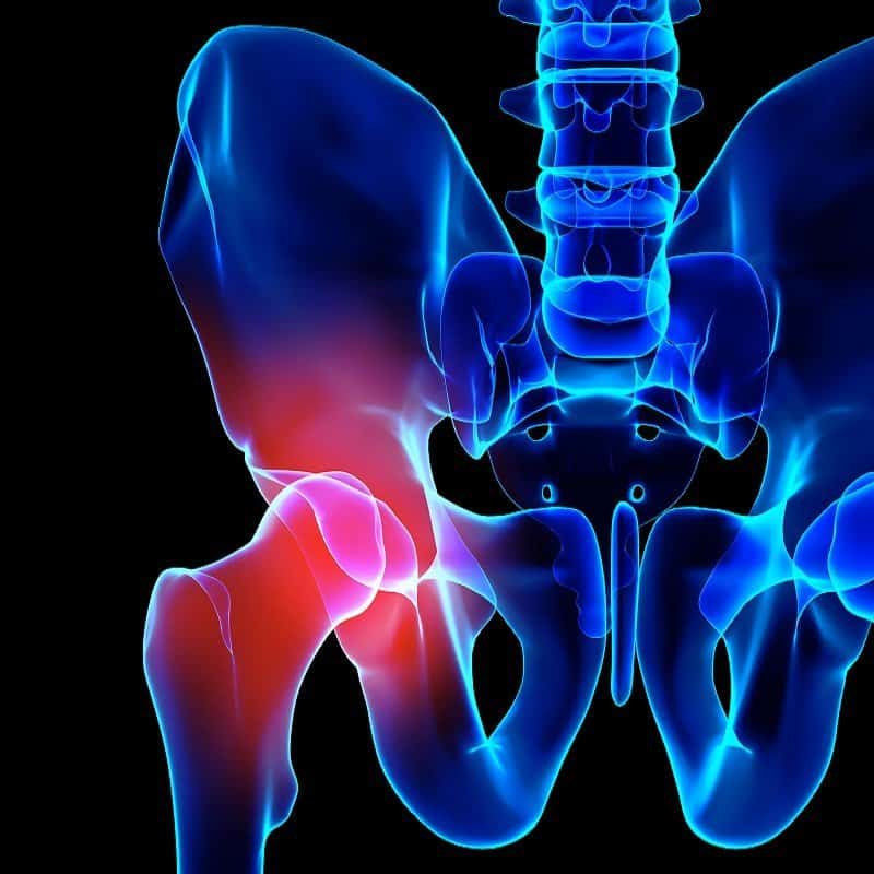 Hip painful skeleton x-ray, 3D illustration. chiropractors in boca for hip pain