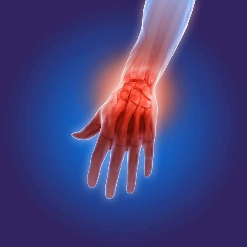 3d illustration of arthritis pain in hand best chiropractor in boca