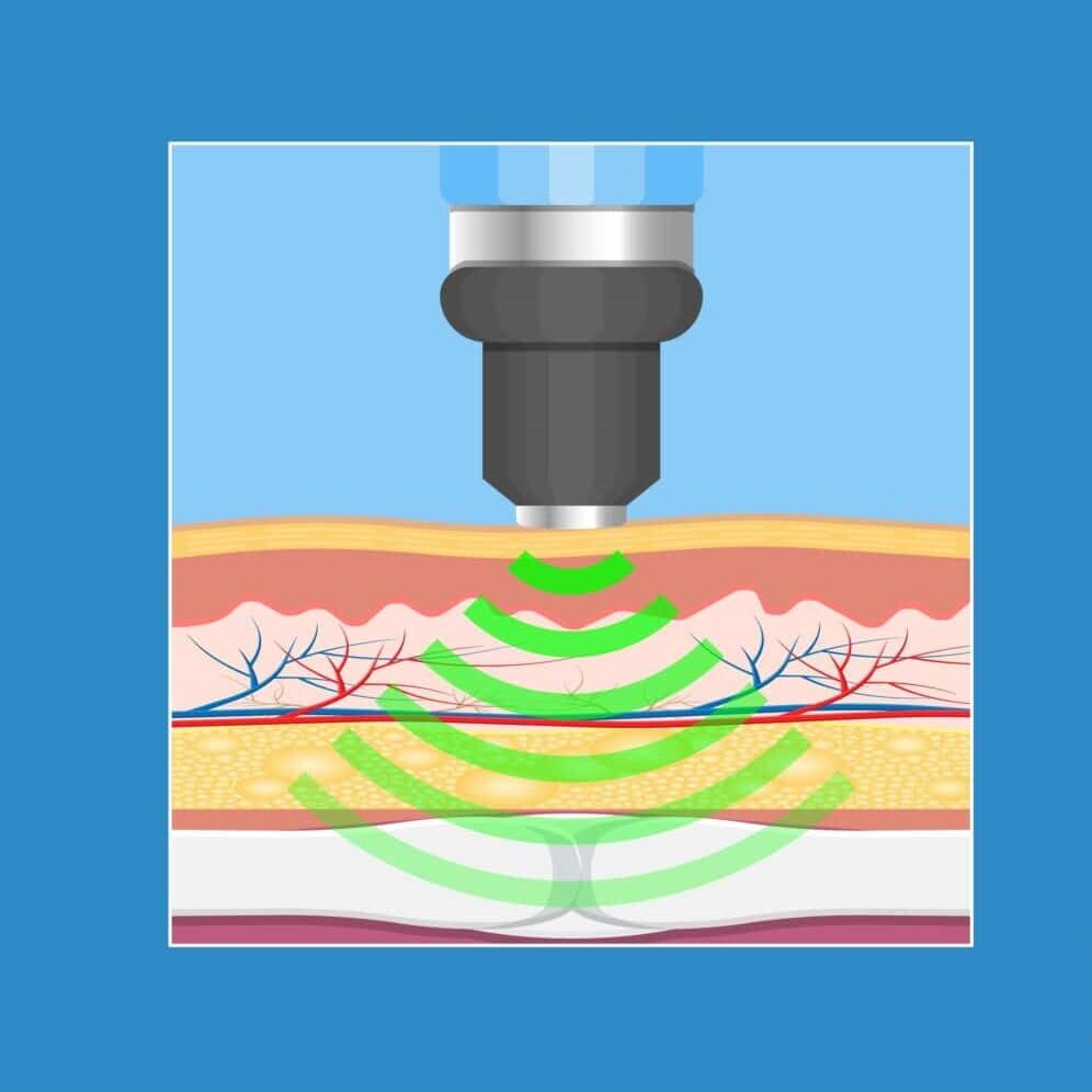shock wave showing peneration